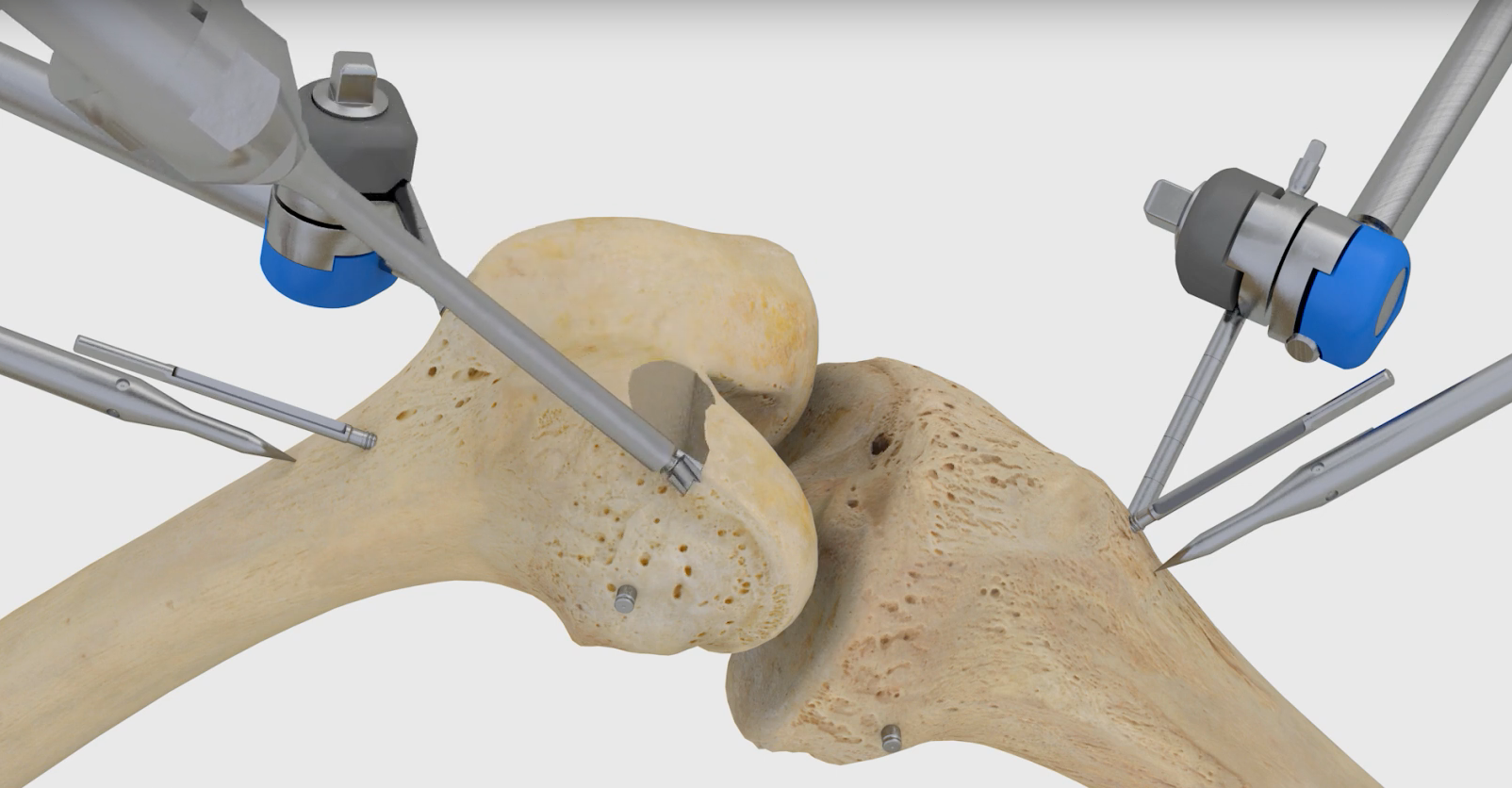 TSolution One robot for total knee replacement receives FDA approval