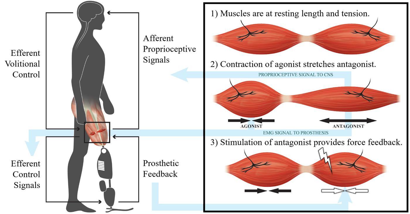 Hugh Herr's MIT Media Lab invented the agonist-antagonist myoneural interface (AMI)