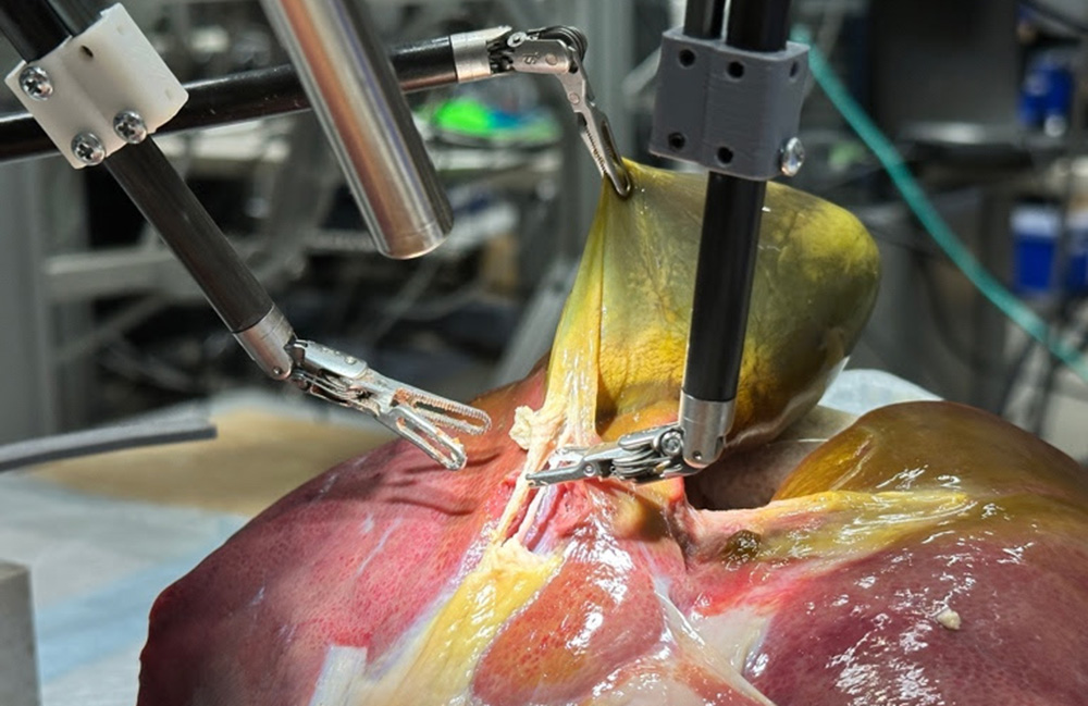 The Surgical Robot Transformer-Hierarchy from Johns Hopkins performing a gallbladder surgery.