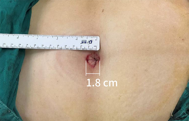 A mimial incision through the navel provides access for a steerable robot, says Surgerii. 