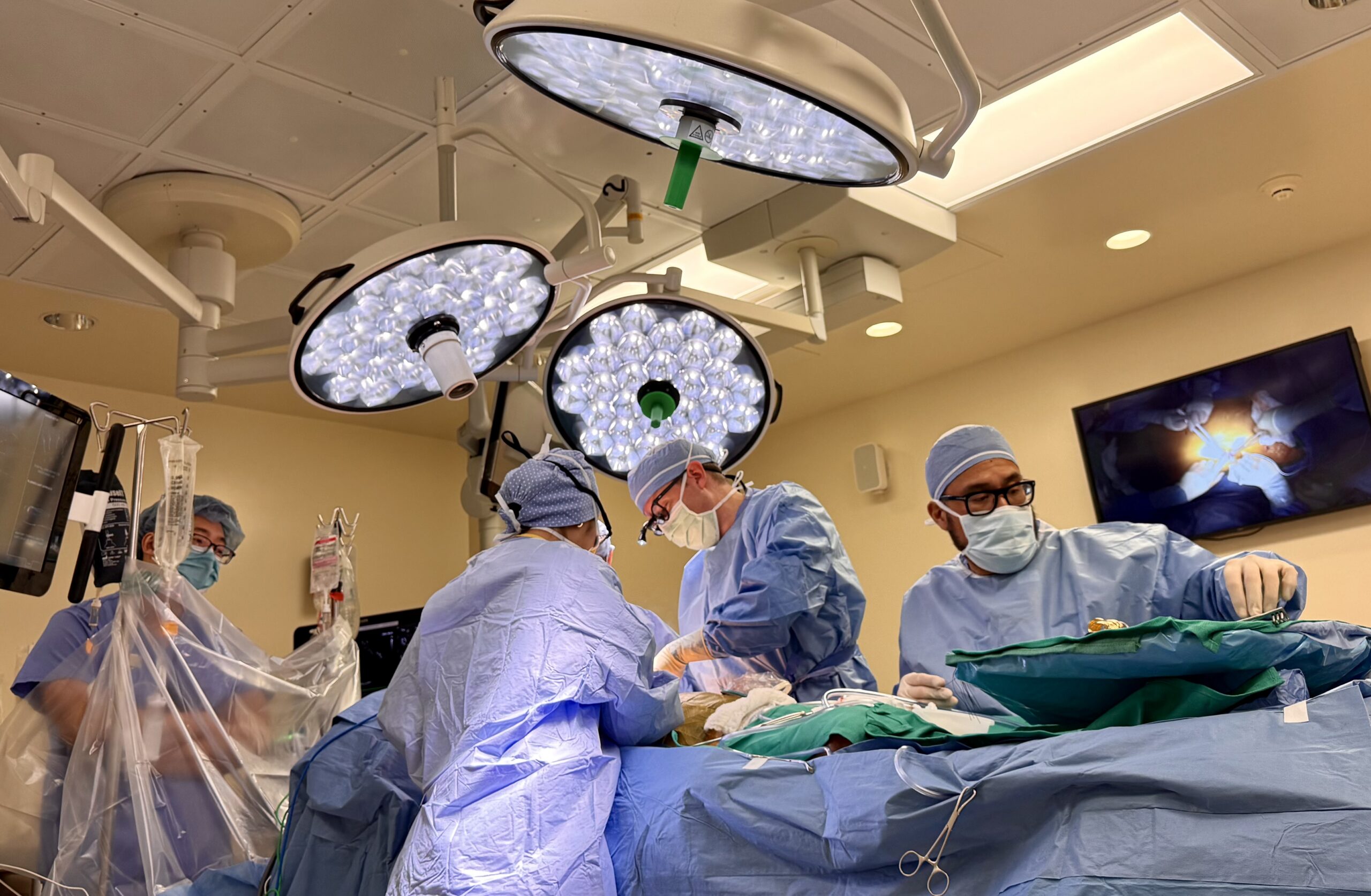 The most common approach to a CABG involves the surgeon opening the chest by dividing the breastbone to reach the heart.