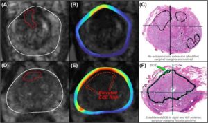 Avenda Health expands Unfold AI platform to support intraoperative prostate cancer care